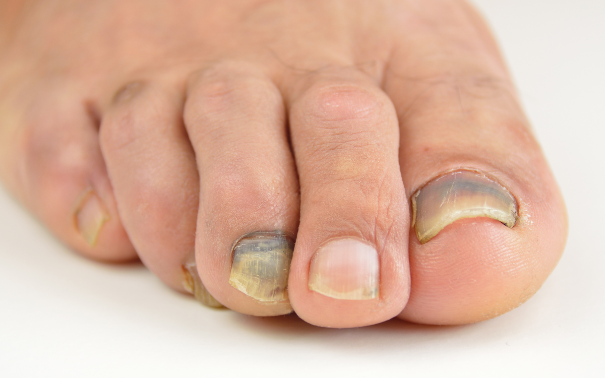 krwiak podpaznokciowy